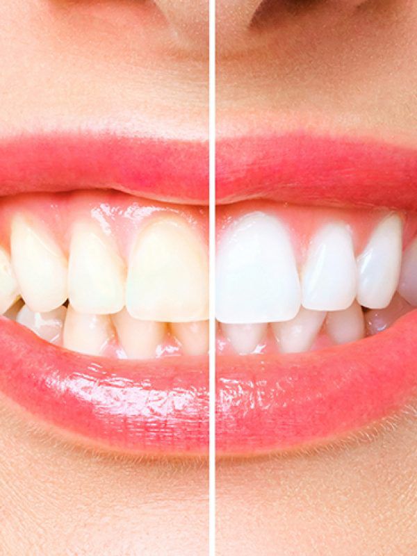 Facettes dentaires pour harmoniser le sourire