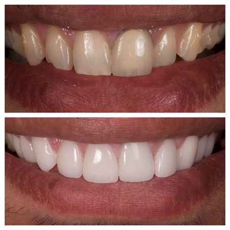 Correction esthétique du sourire en clinique dentaire