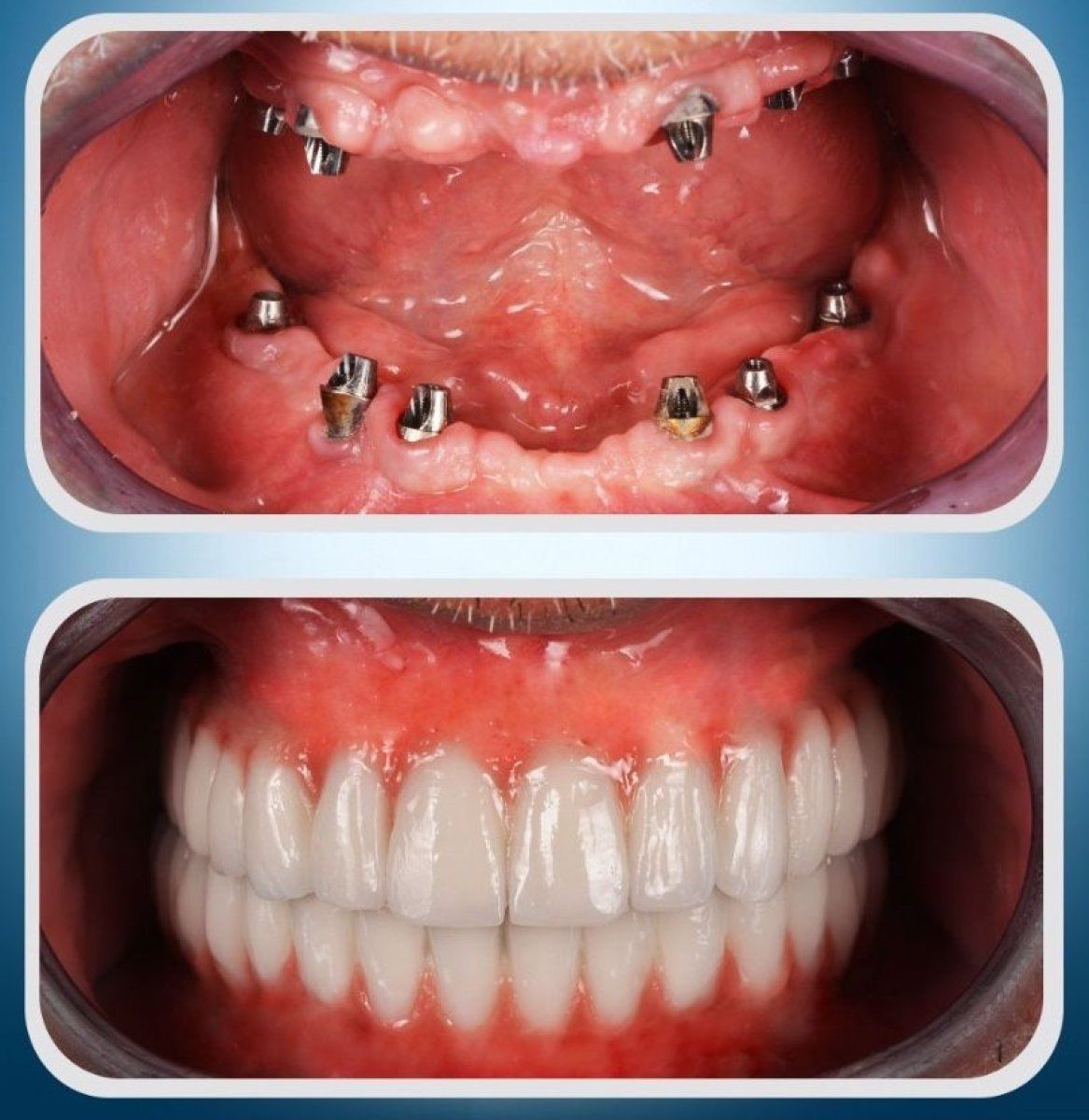 Pose d'implant dentaire pour remplacer une dent manquante