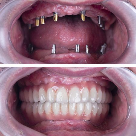 Résultat d'implant dentaire naturel et durable