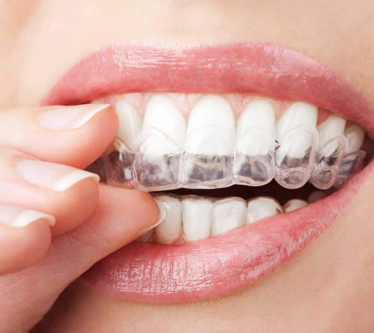 Aligneurs transparents pour orthodontie discrète