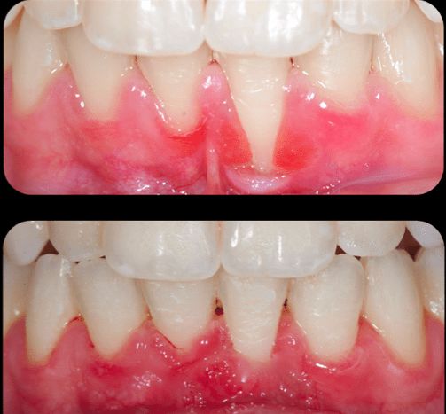 Soin parodontal pour stabiliser la santé bucco-dentaire