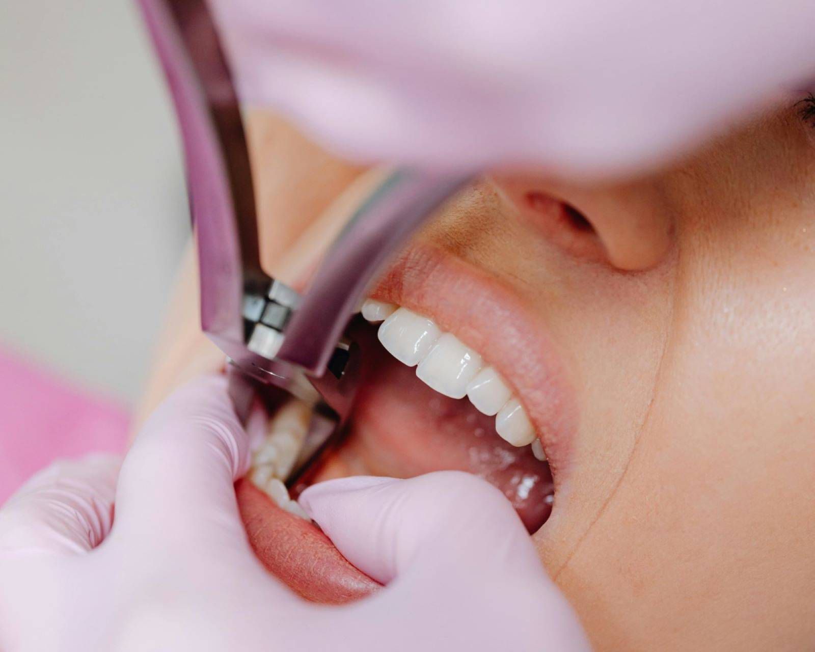 Traitement dentaire conservateur pour un sourire sain